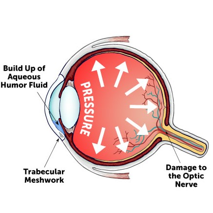 Glaucoma